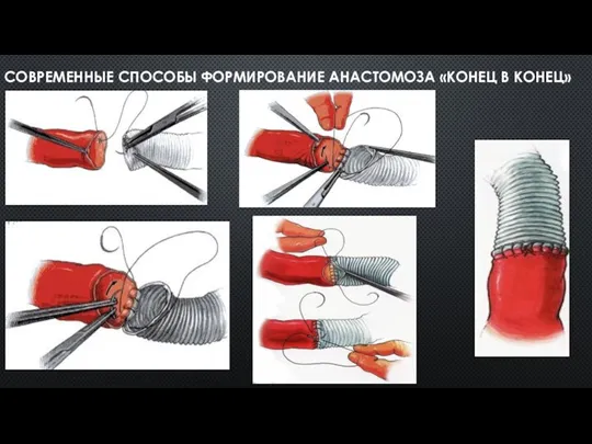 СОВРЕМЕННЫЕ СПОСОБЫ ФОРМИРОВАНИЕ АНАСТОМОЗА «КОНЕЦ В КОНЕЦ»