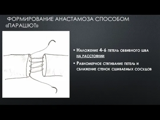 ФОРМИРОВАНИЕ АНАСТАМОЗА СПОСОБОМ «ПАРАШЮТ» Наложение 4-6 петель обвивного шва на