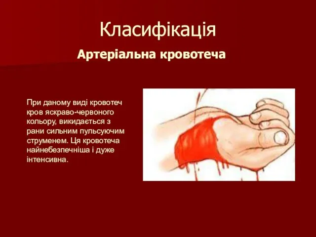Класифікація Артеріальна кровотеча При даному виді кровотеч кров яскраво-червоного кольору,