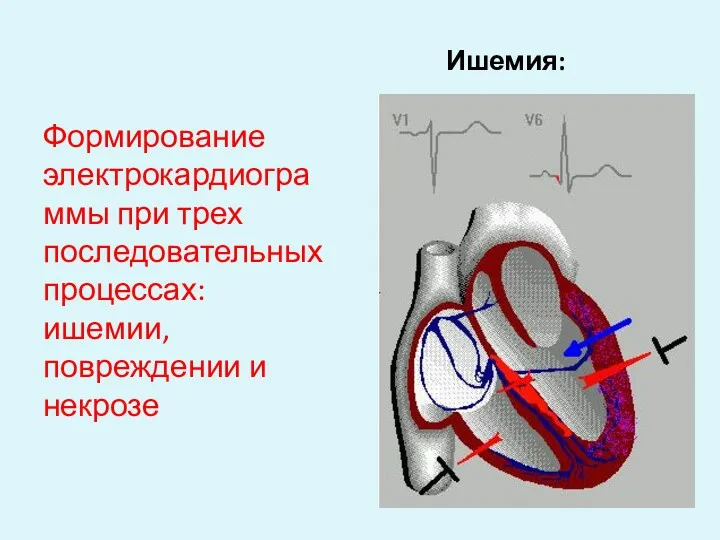 Ишемия: Формирование электрокардиограммы при трех последовательных процессах: ишемии, повреждении и некрозе