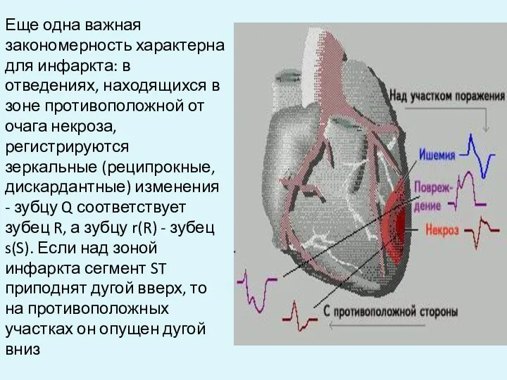 Еще одна важная закономерность характерна для инфаркта: в отведениях, находящихся