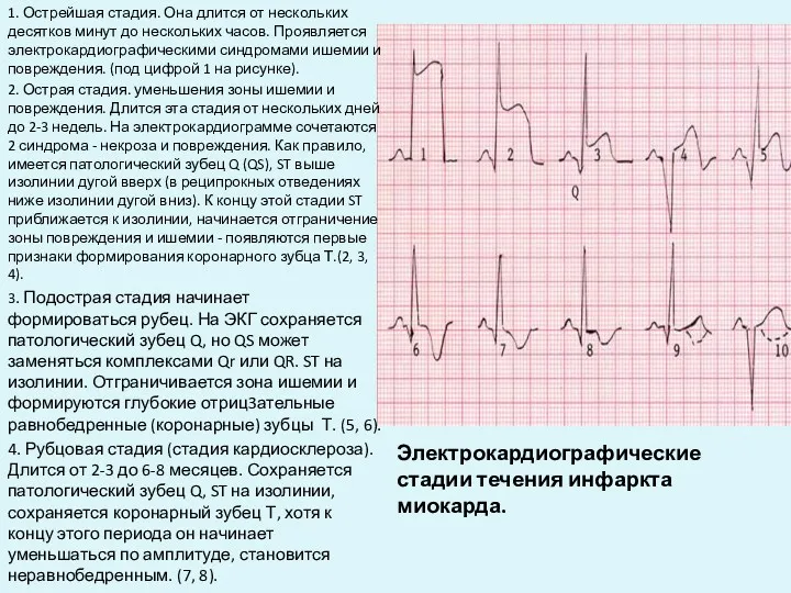 Электрокардиографические стадии течения инфаркта миокарда. 1. Острейшая стадия. Она длится