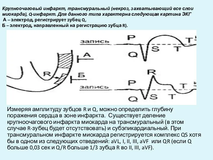 Крупноочаговый инфаркт, трансмуральный (некроз, захватывающий все слои миокарда), Q-инфаркт. Для