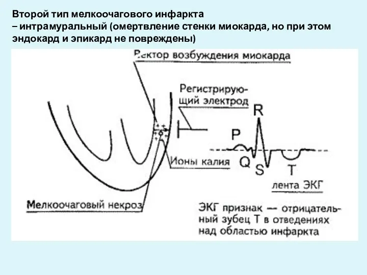 Второй тип мелкоочагового инфаркта – интрамуральный (омертвление стенки миокарда, но