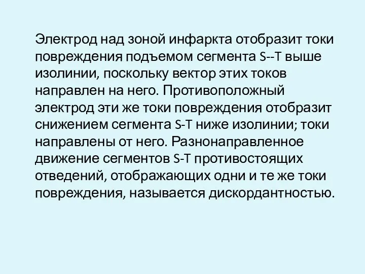 Электрод над зоной инфаркта отобразит токи повреждения подъемом сегмента S--T