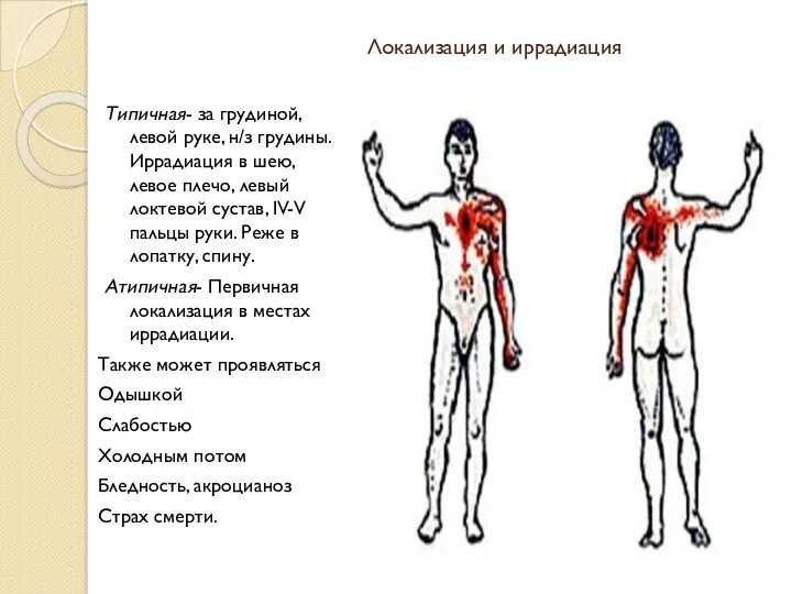 Локализация и иррадиация Типичная- за грудиной, левой руке, н/з грудины.