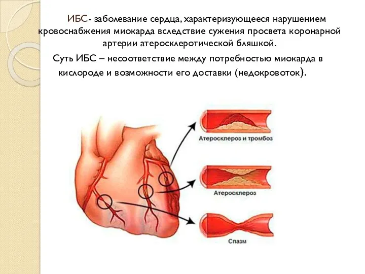 ИБС- заболевание сердца, характеризующееся нарушением кровоснабжения миокарда вследствие сужения просвета