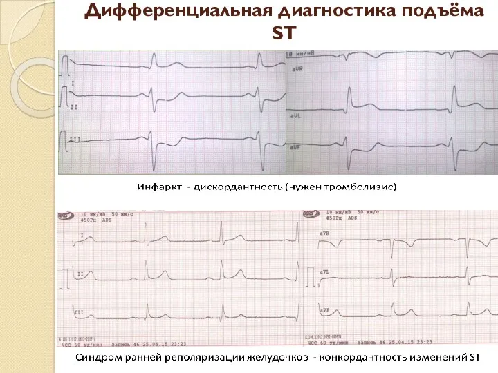 Дифференциальная диагностика подъёма ST