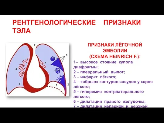 РЕНТГЕНОЛОГИЧЕСКИЕ ПРИЗНАКИ ТЭЛА 1– высокое стояние купола диафрагмы; 2 –