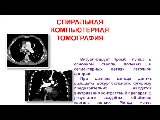 СПИРАЛЬНАЯ КОМПЬЮТЕРНАЯ ТОМОГРАФИЯ Визуализирует тромб, лучше в основном стволе, долевых