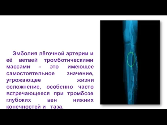 Эмболия лёгочной артерии и её ветвей тромботическими массами - это