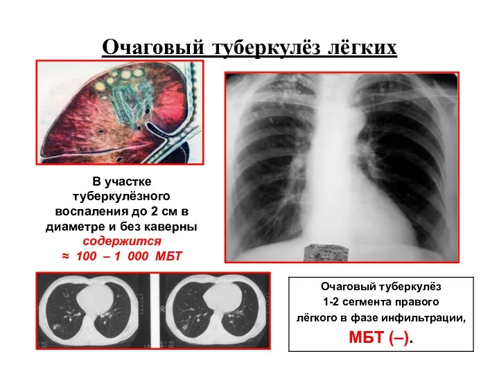 Очаговый туберкулёз лёгких В участке туберкулёзного воспаления до 2 см