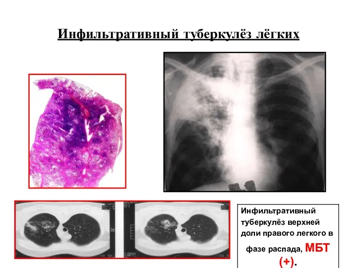 Инфильтративный туберкулёз лёгких