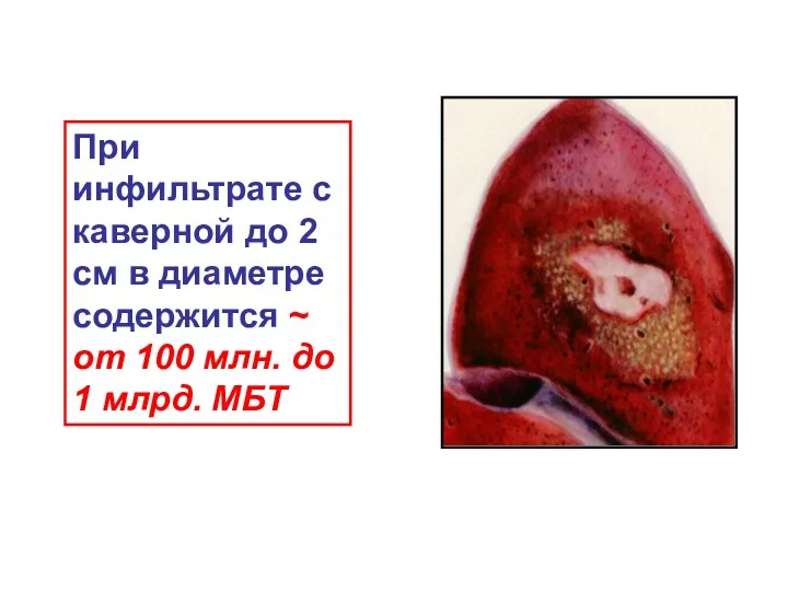При инфильтрате с каверной до 2 см в диаметре содержится
