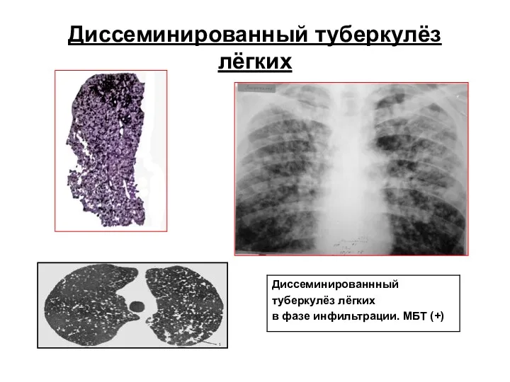 Диссеминированный туберкулёз лёгких