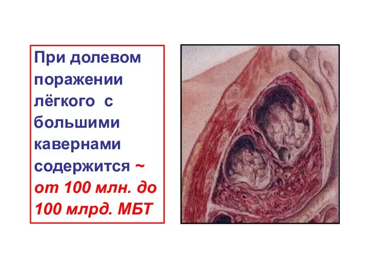 При долевом поражении лёгкого с большими кавернами содержится ~ от 100 млн. до 100 млрд. МБТ