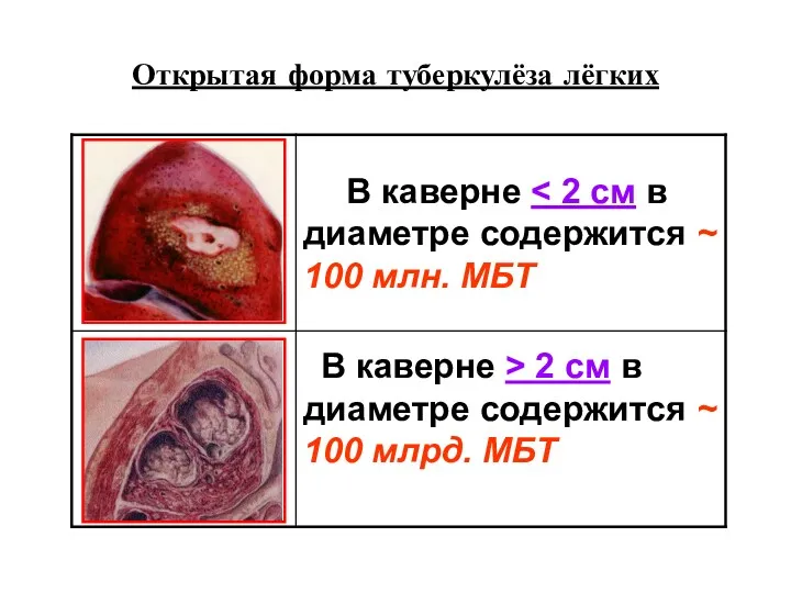 Открытая форма туберкулёза лёгких