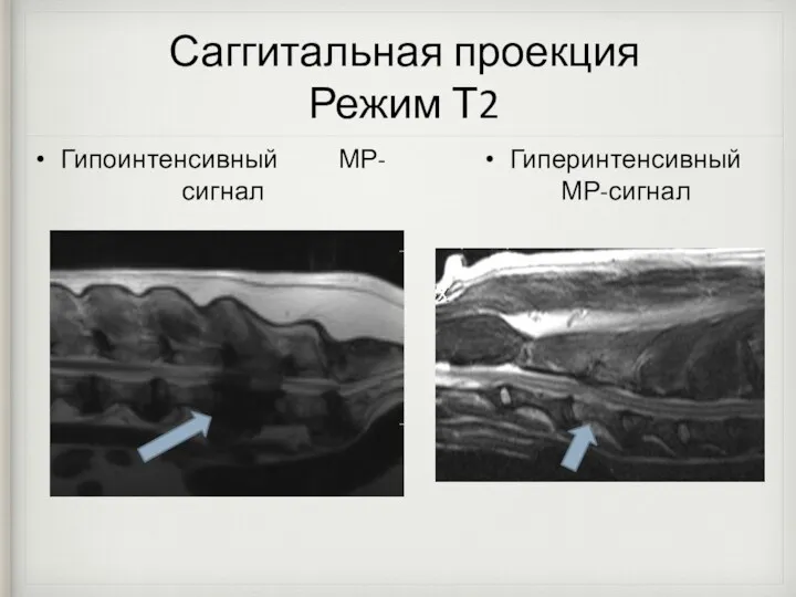 Саггитальная проекция Режим Т2 Гипоинтенсивный МР-сигнал Гиперинтенсивный МР-сигнал