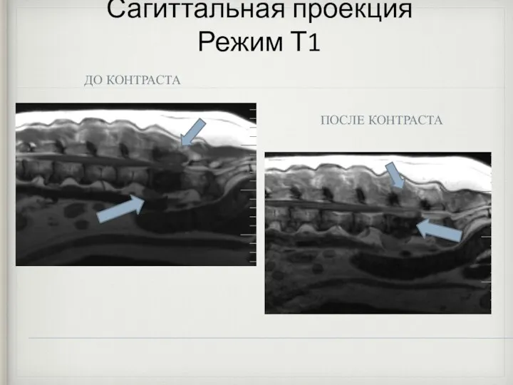 Сагиттальная проекция Режим Т1 ДО КОНТРАСТА ПОСЛЕ КОНТРАСТА