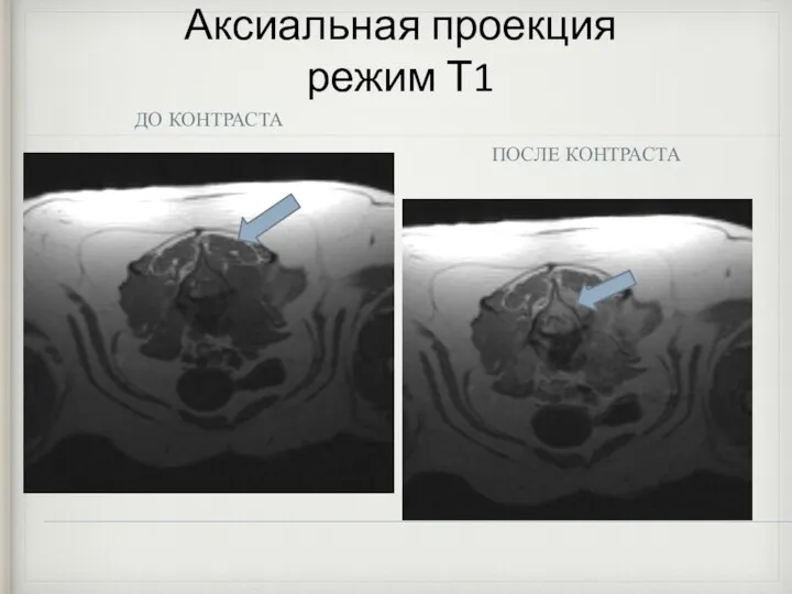 Аксиальная проекция режим Т1 ДО КОНТРАСТА ПОСЛЕ КОНТРАСТА