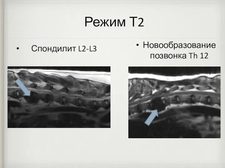 Режим Т2 Спондилит L2-L3 Новообразование позвонка Th 12