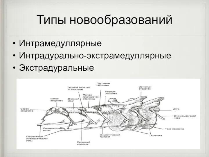 Типы новообразований Интрамедуллярные Интрадурально-экстрамедуллярные Экстрадуральные