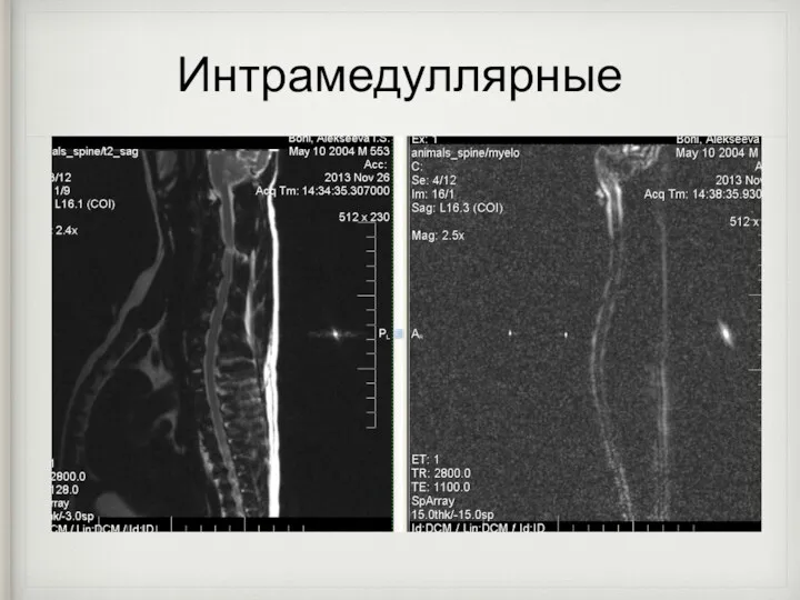 Интрамедуллярные