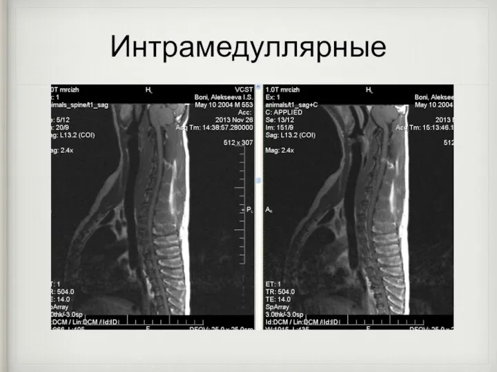 Интрамедуллярные