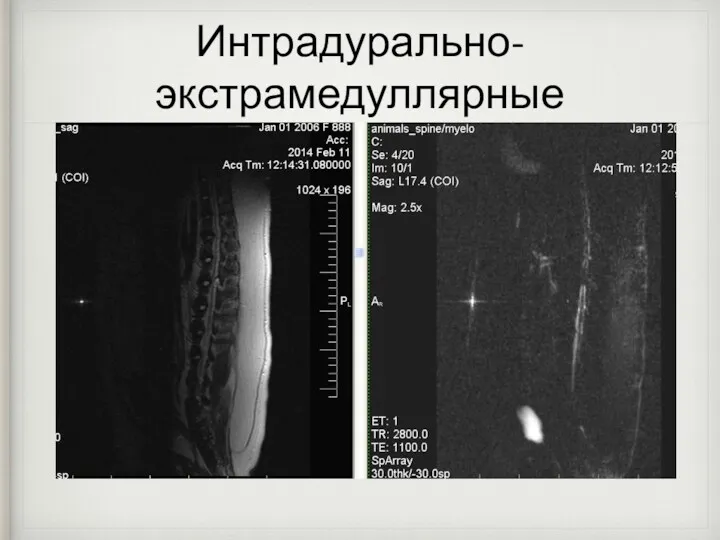 Интрадурально-экстрамедуллярные