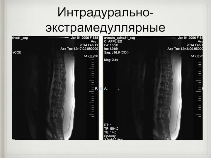 Интрадурально-экстрамедуллярные