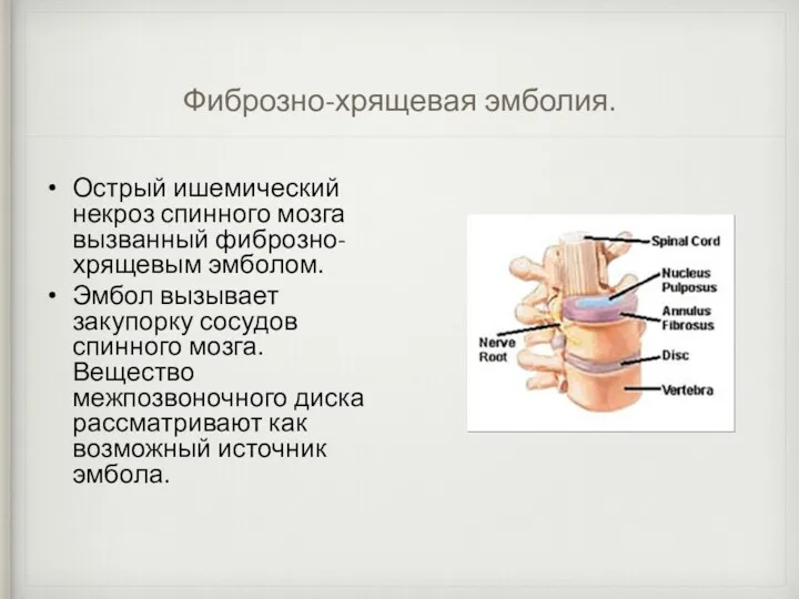 Фиброзно-хрящевая эмболия. Острый ишемический некроз спинного мозга вызванный фиброзно-хрящевым эмболом.