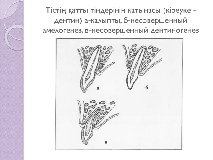 Тістің қатты тіндерінің қатынасы (кіреуке -дентин) а-қалыпты, б-несовершенный амелогенез, в-несовершенный дентиногенез
