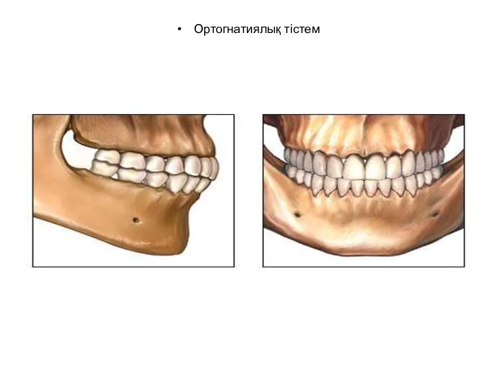 Ортогнатиялық тістем