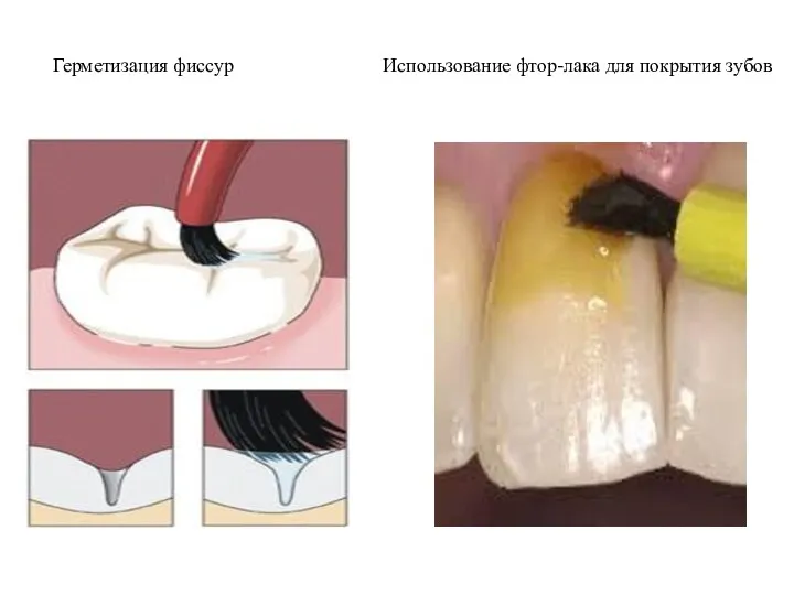 Герметизация фиссур Использование фтор-лака для покрытия зубов