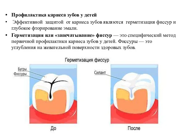 Профилактика кариеса зубов у детей Эффективной защитой от кариеса зубов
