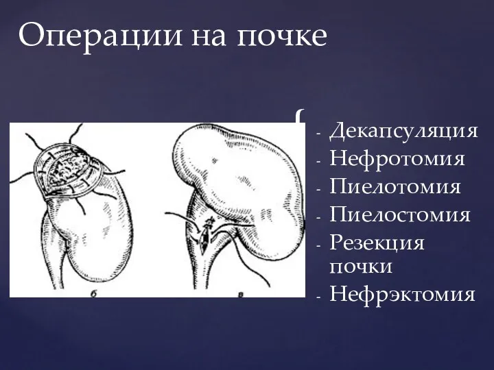 Декапсуляция Нефротомия Пиелотомия Пиелостомия Резекция почки Нефрэктомия Операции на почке