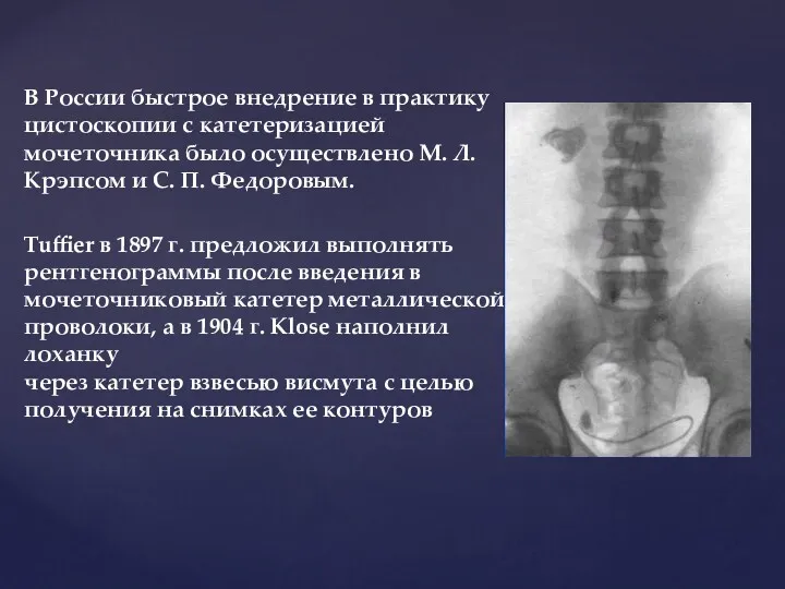 В России быстрое внедрение в практику цистоскопии с катетеризацией мочеточника было осуществлено М.