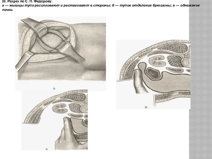 33. Разрез по С. П. Федорову. а — мышцы тупо