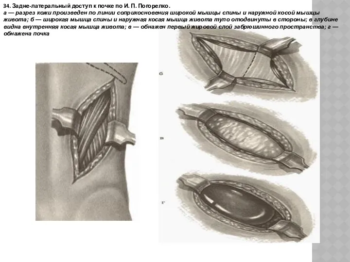 34. Задне-латеральный доступ к почке по И. П. Погорелко. а