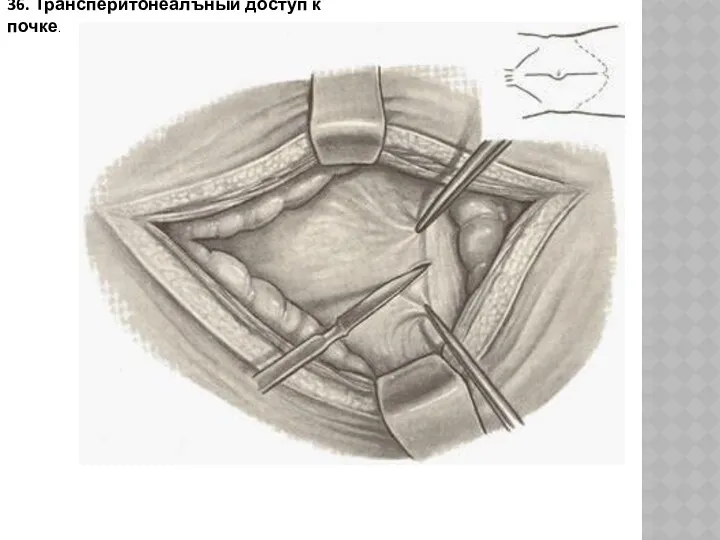 36. Трансперитонеалъный доступ к почке.