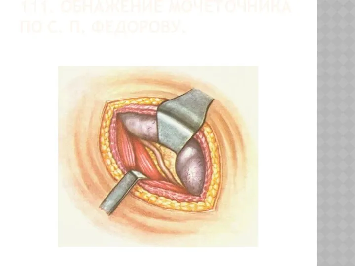 111. ОБНАЖЕНИЕ МОЧЕТОЧНИКА ПО С. П. ФЕДОРОВУ.