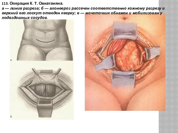 113. Операция К. Т. Овнатаняна. а — линия разреза; б