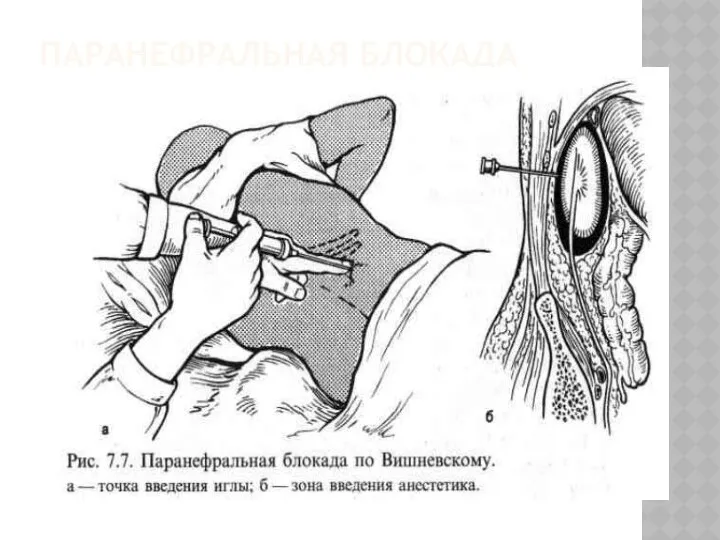 ПАРАНЕФРАЛЬНАЯ БЛОКАДА