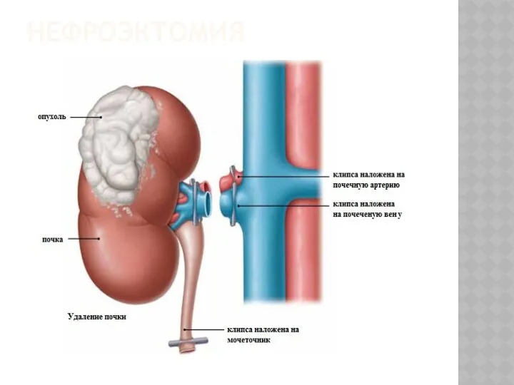 НЕФРОЭКТОМИЯ