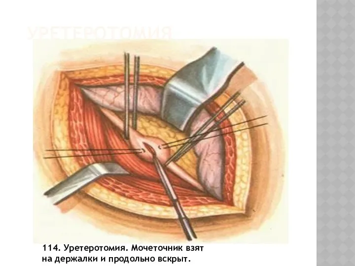 УРЕТЕРОТОМИЯ 114. Уретеротомия. Мочеточник взят на держалки и продольно вскрыт.