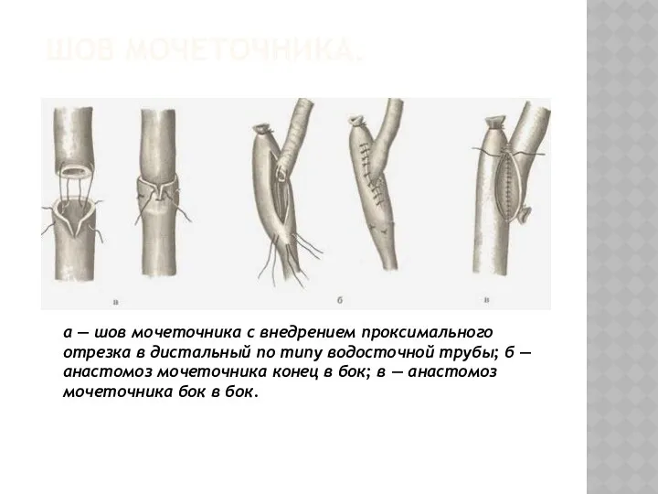 ШОВ МОЧЕТОЧНИКА. а — шов мочеточника с внедрением проксимального отрезка