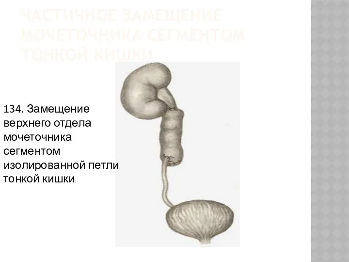 ЧАСТИЧНОЕ ЗАМЕЩЕНИЕ МОЧЕТОЧНИКА СЕГМЕНТОМ ТОНКОЙ КИШКИ 134. Замещение верхнего отдела мочеточника сегментом изолированной петли тонкой кишки.