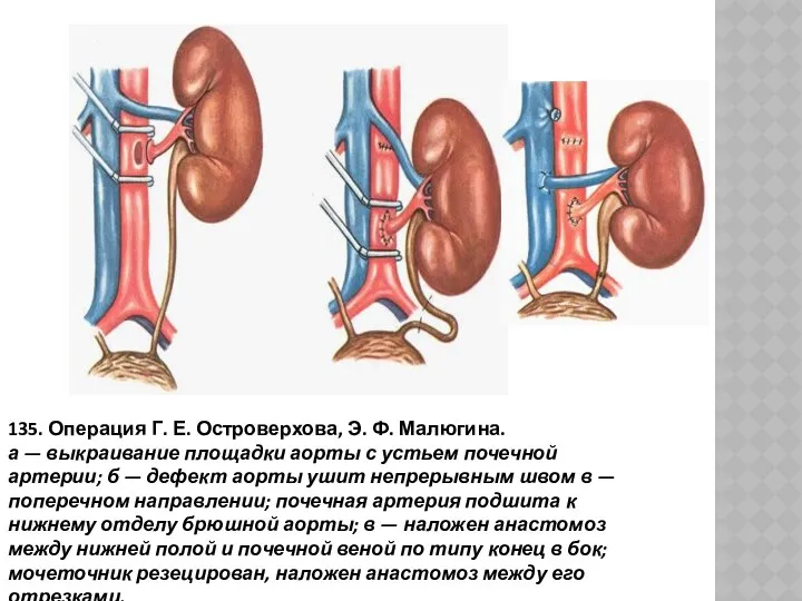 135. Операция Г. Е. Островерхова, Э. Ф. Малюгина. а —