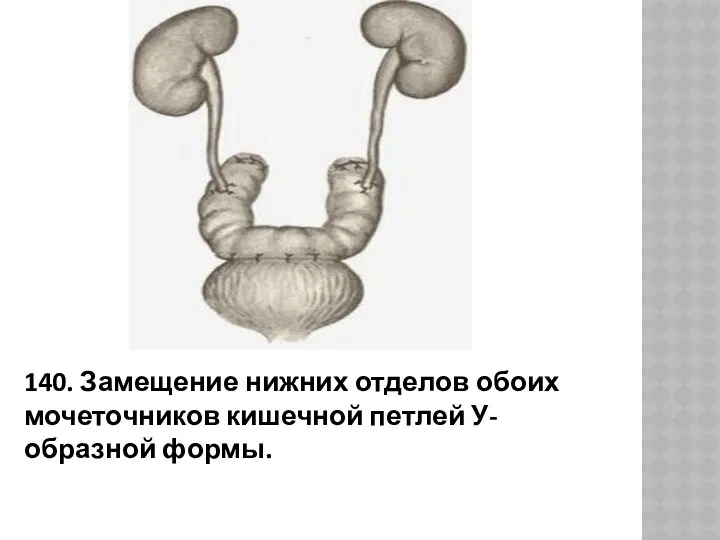 140. Замещение нижних отделов обоих мочеточников кишечной петлей У-образной формы.