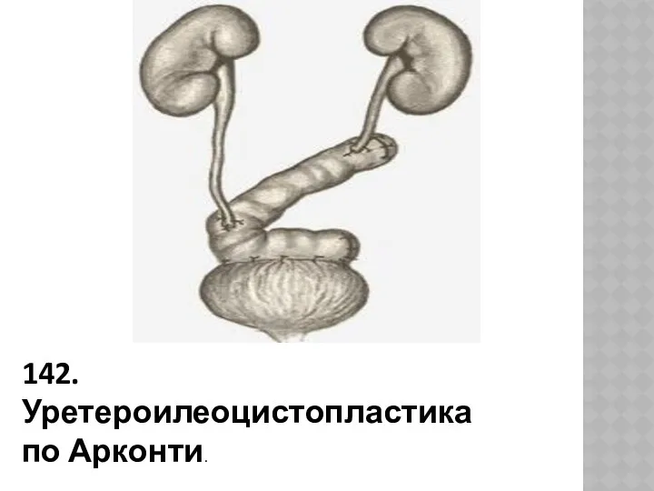 142. Уретероилеоцистопластика по Арконти.